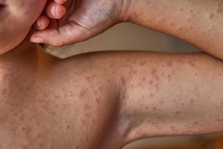 Hives in Adults: Causes, Symptoms, and Effective Treatments