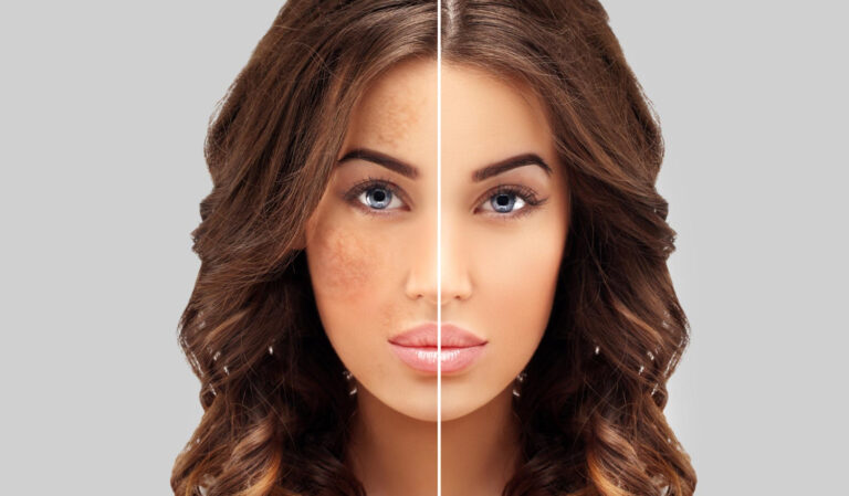 Best Dermatological Treatments for Pigmentation Reduction in 2025