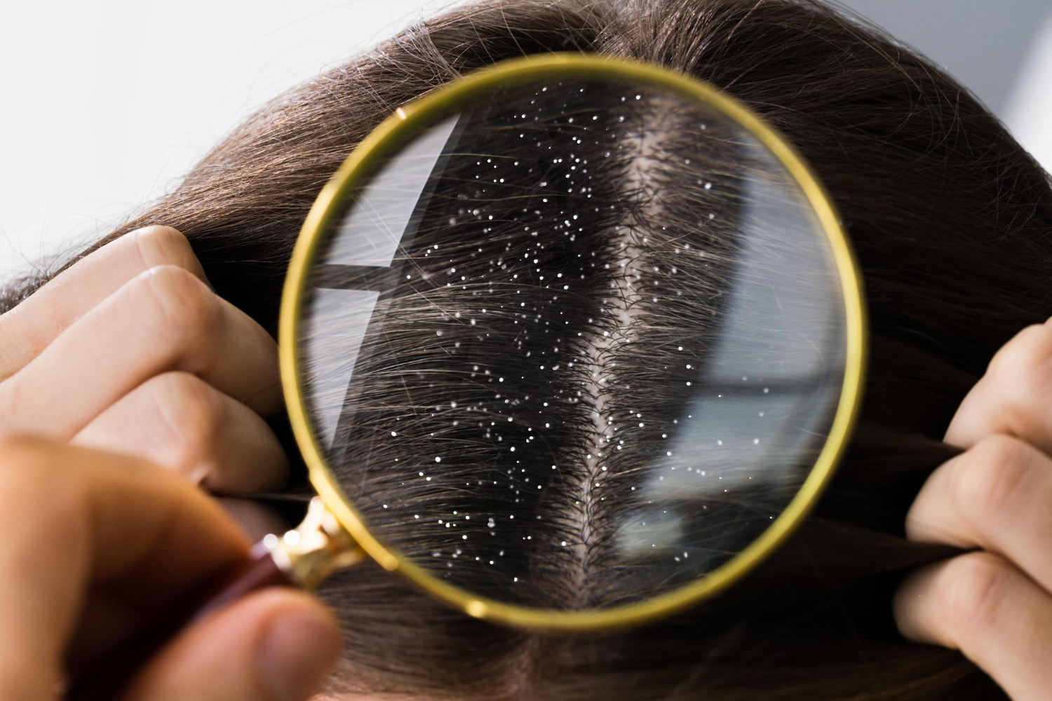 Anti Dandruff Treatment