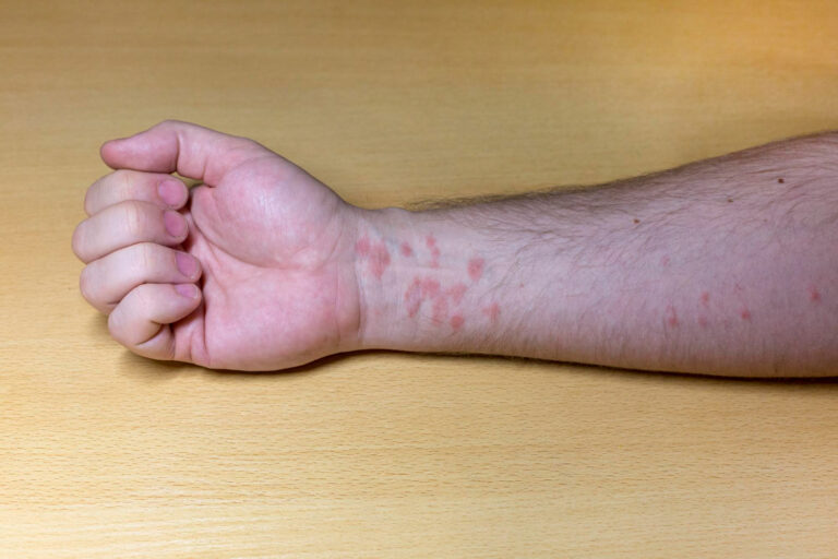 hives in adults causes symptomstreatment
