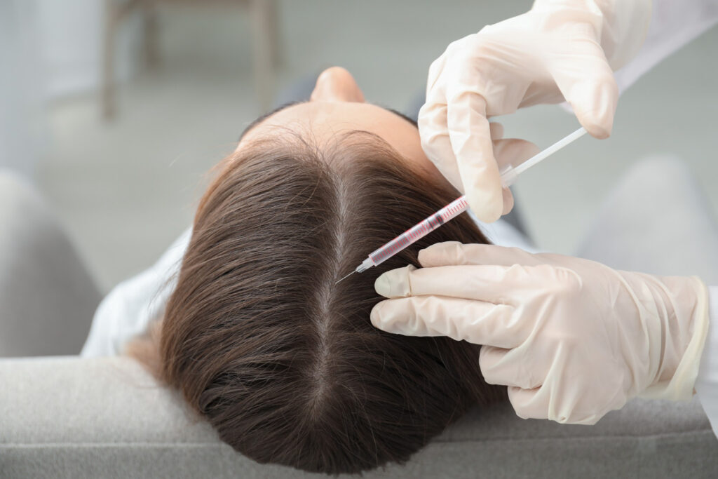 PRP hair treatment