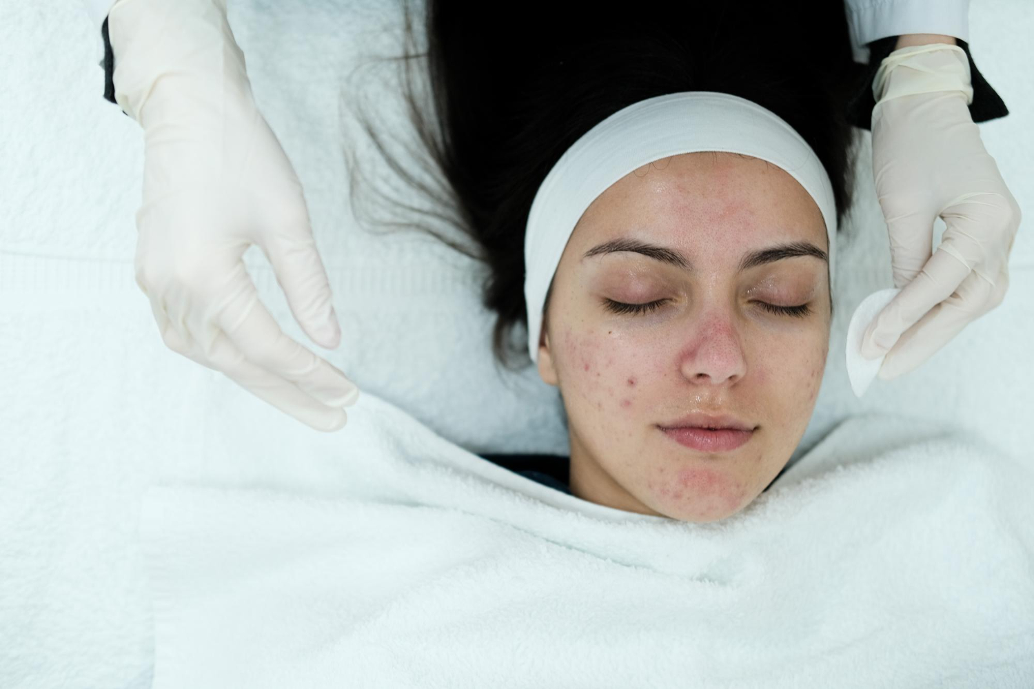 Acne & Scar Removal Solutions