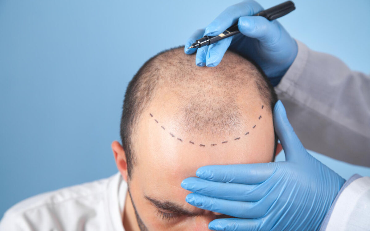 Hair Transplant Results