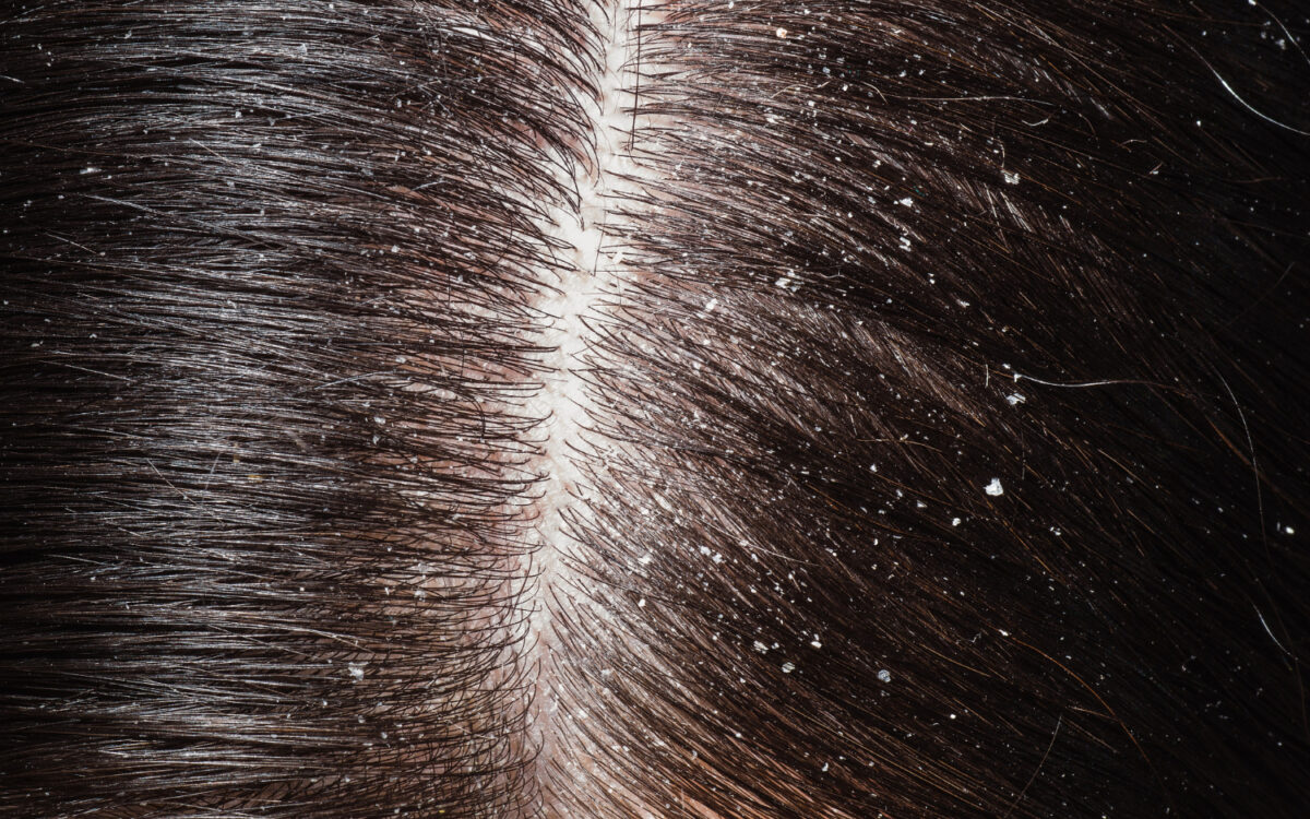 Types of Dandruff