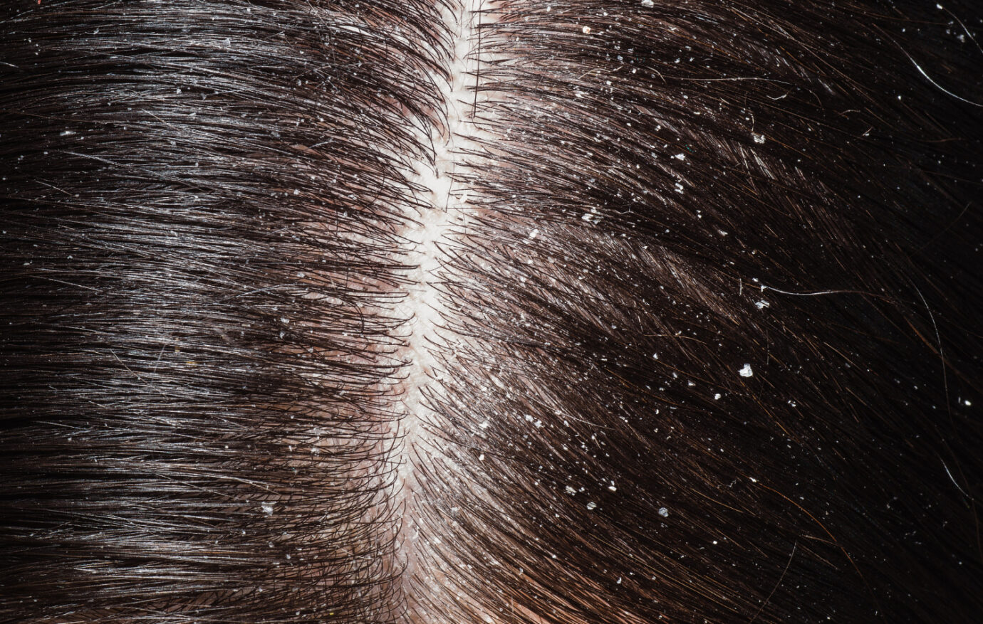 Types of Dandruff