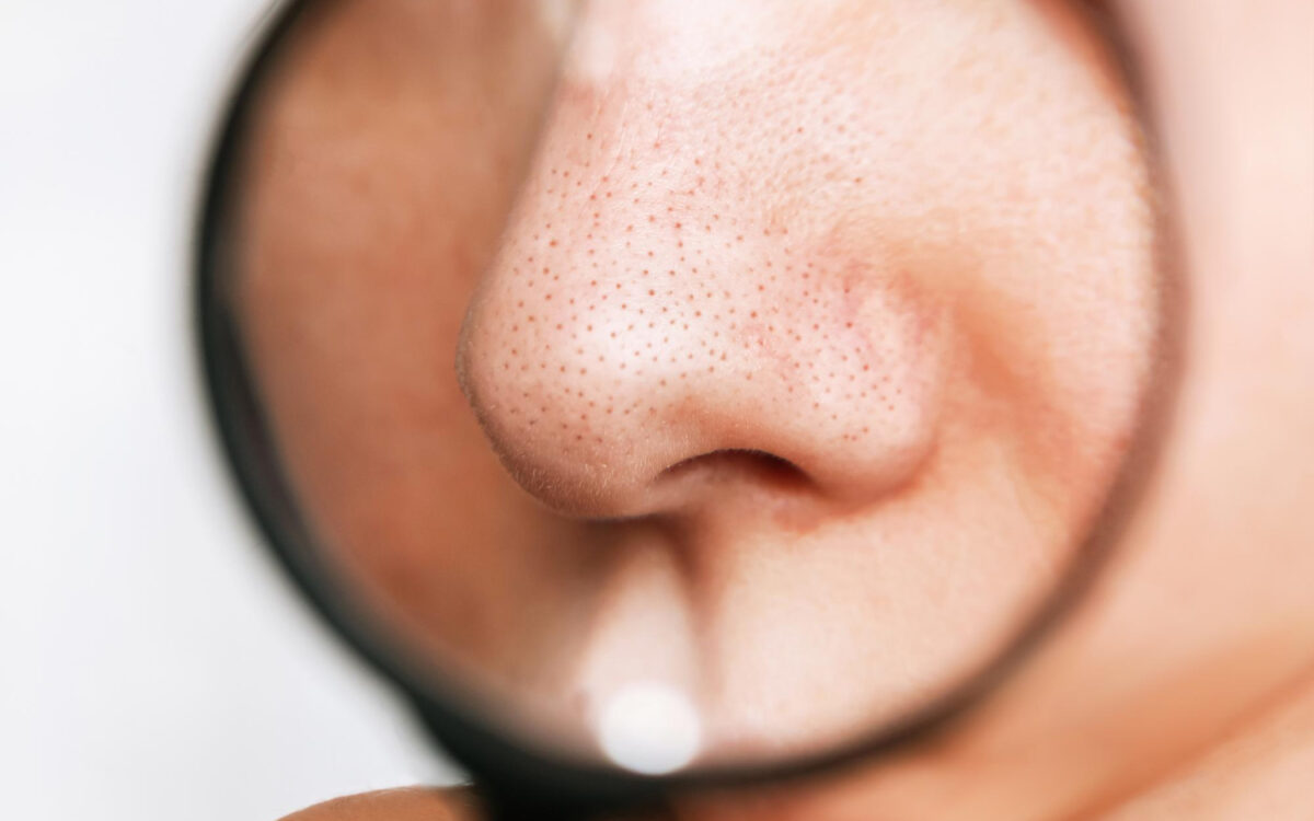 Open Pores on Face: