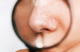 Open Pores on Face: Causes, Best Treatments, Cost & Prevention Tips
