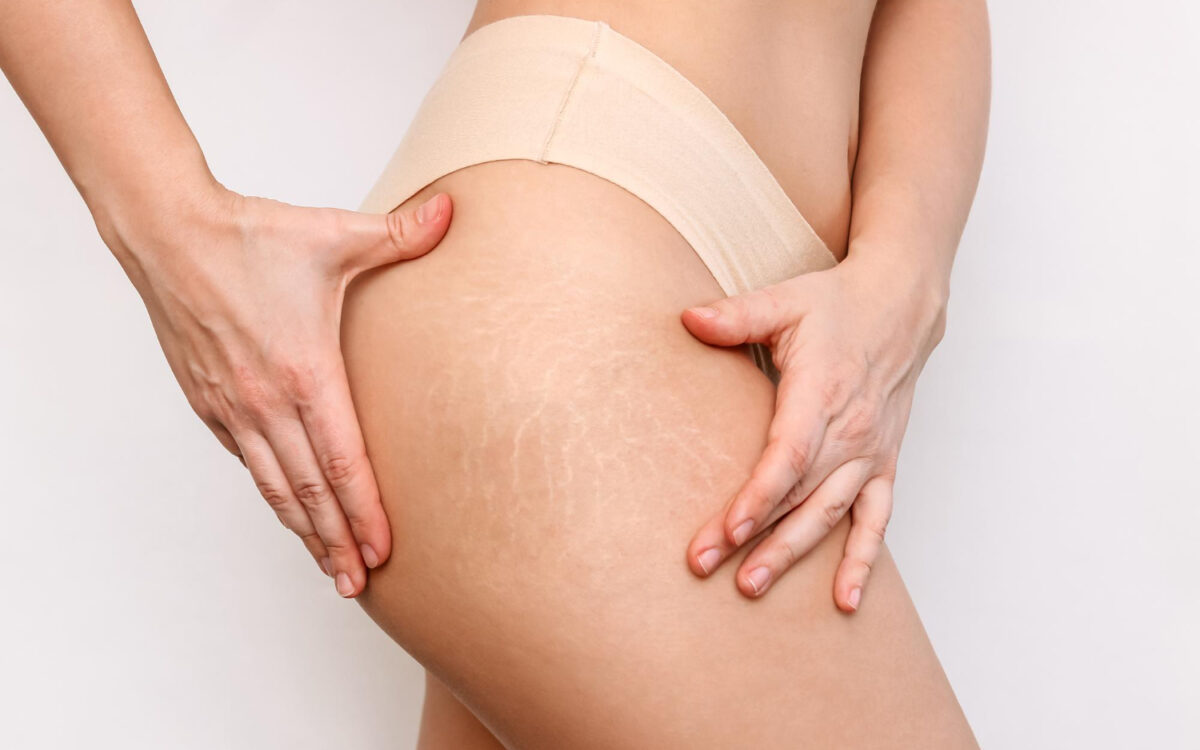 Stretch Marks