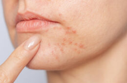 Acne Scar Treatment Myths and Facts: What Actually Works