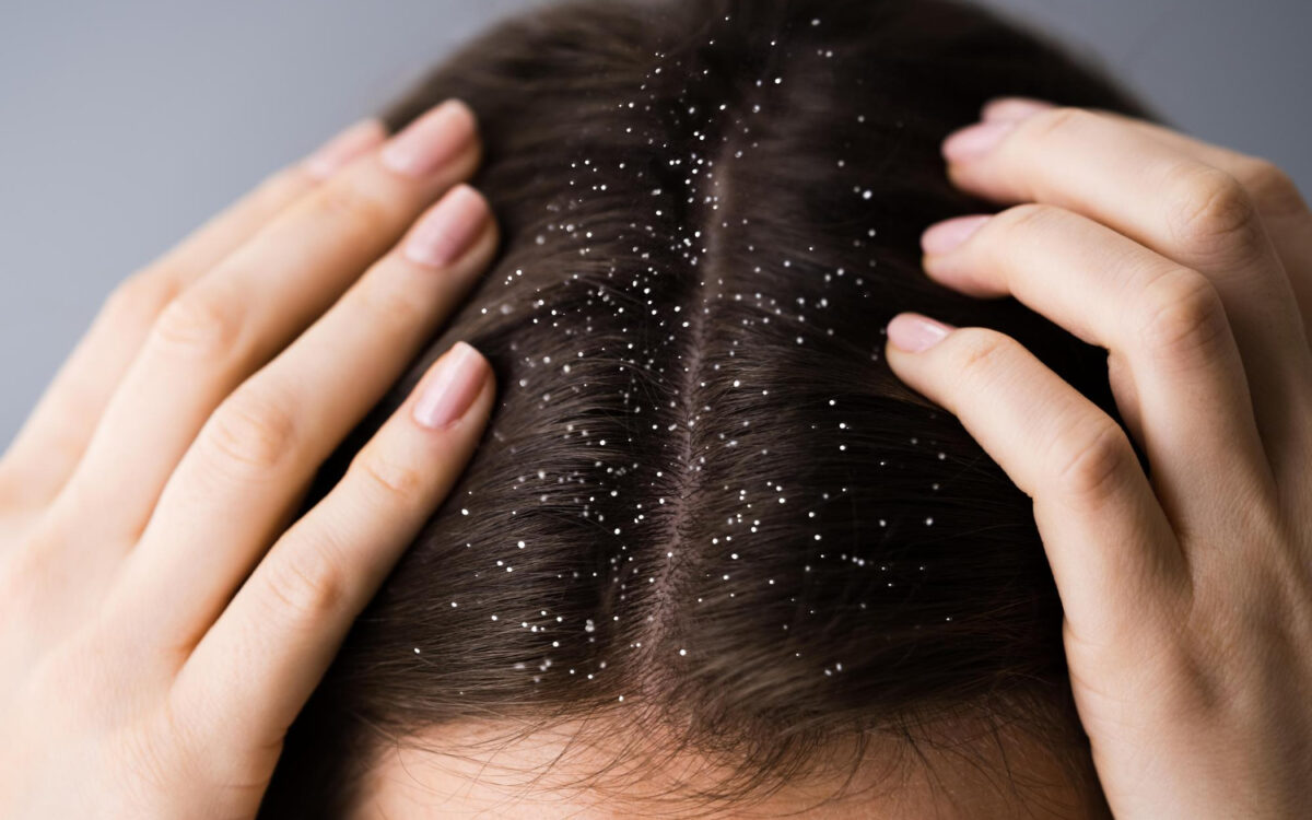 Oily Dandruff vs Dry Dandruff