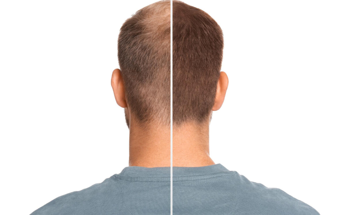 FUE vs DHI vs DHT: Which Hair Transplant