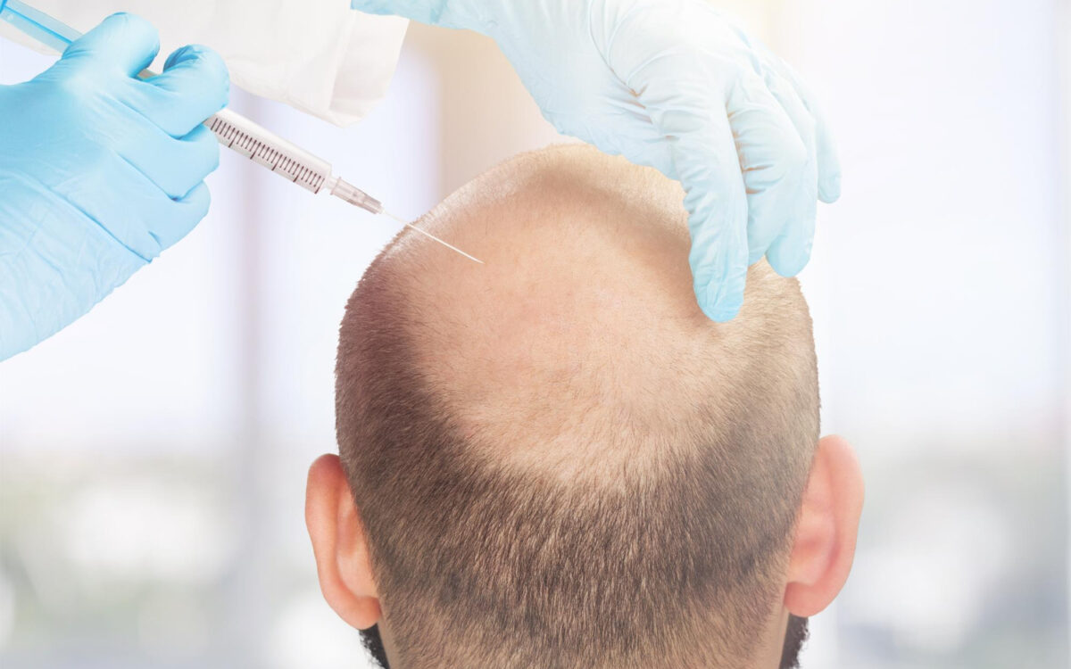 FUE Hair Transplant