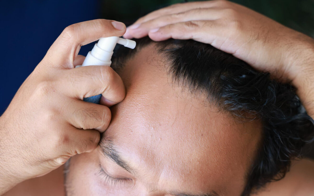 Redensyl vs Minoxidil