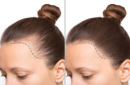 Hairline Design: The Most Important Step for Natural Hair Transplant Results