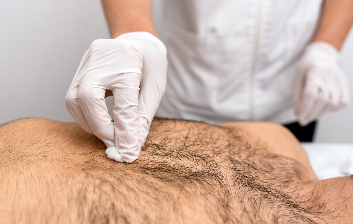 Body Hair Transplant