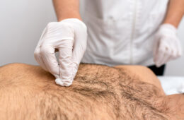 Body Hair Transplant in 2026: Advanced BHT Techniques Using Beard & Chest Hair for Scalp Restoration