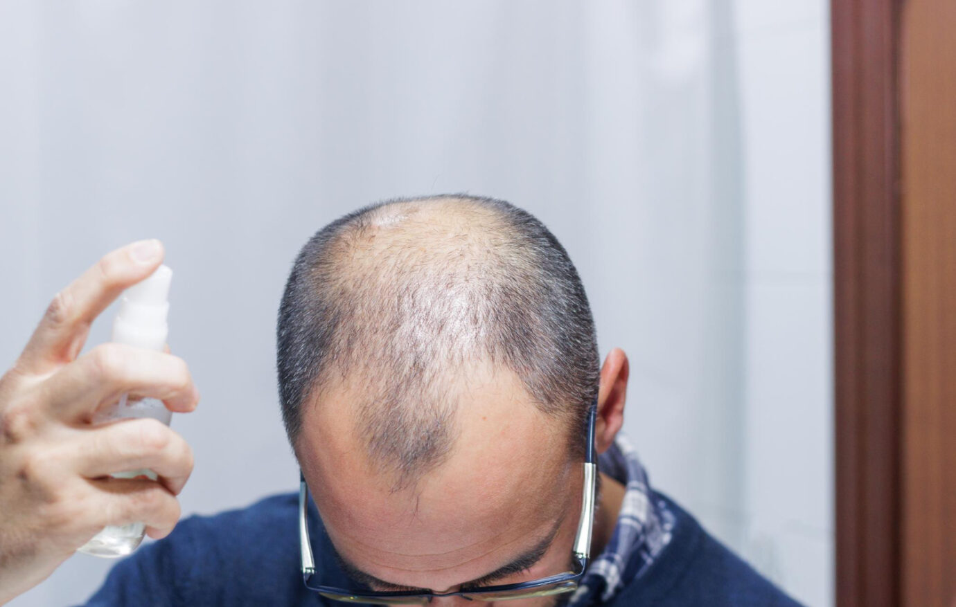 Post Hair Transplant Care Tips