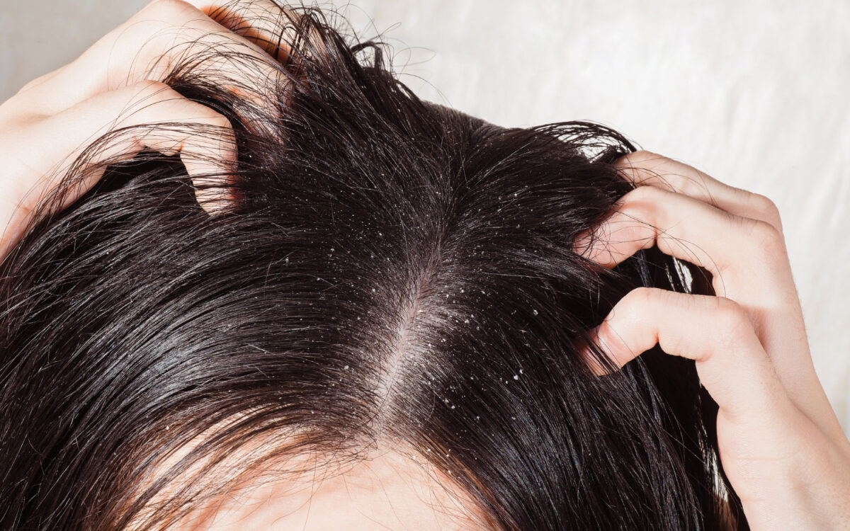 Dandruff vs Dry Scalp