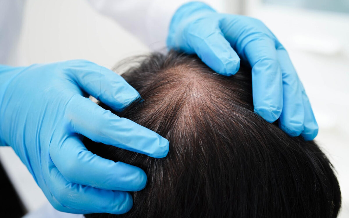 Genetic Hair Loss