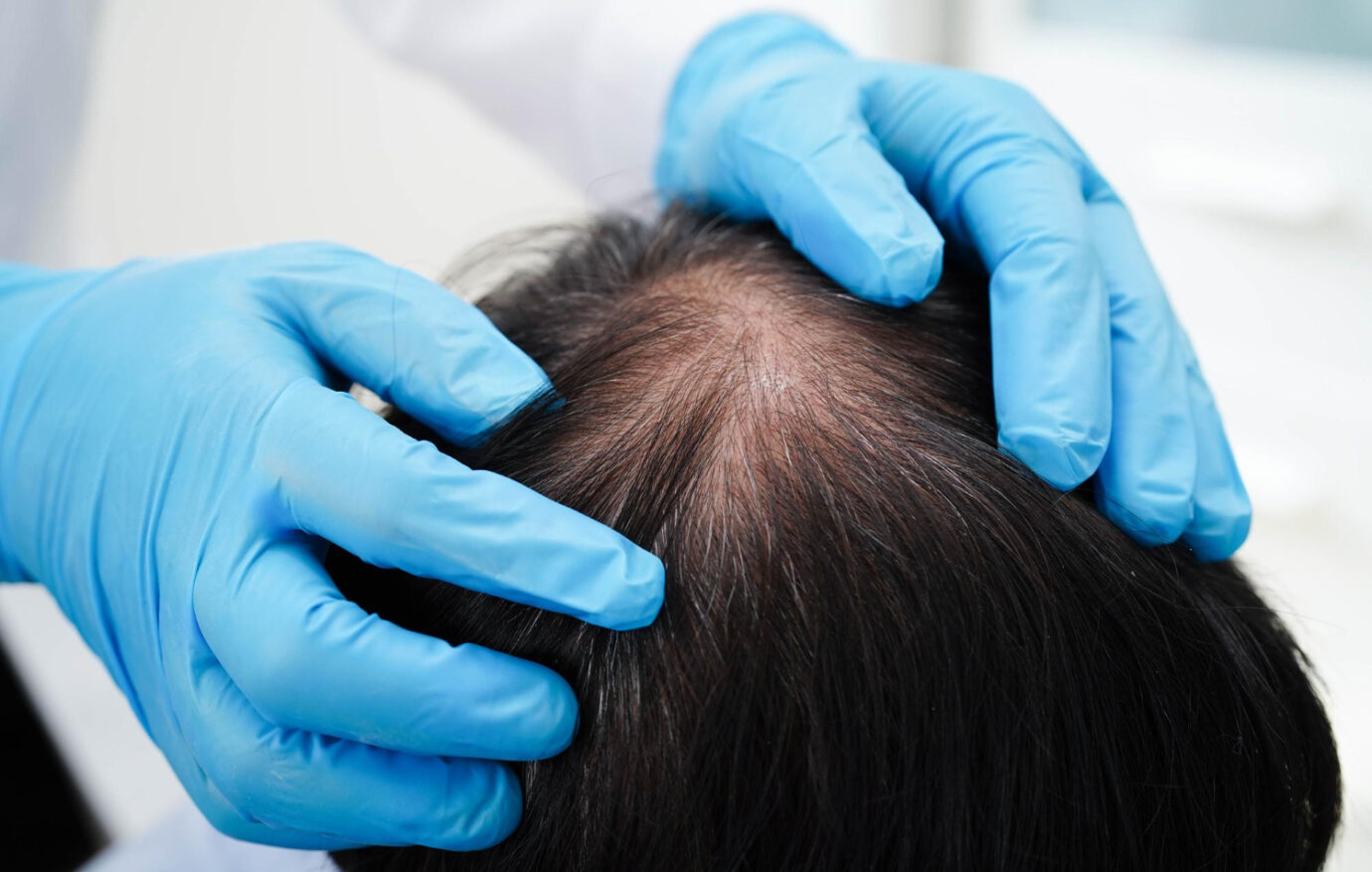 Genetic Hair Loss