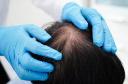 Genetic Hair Loss: Causes, Symptoms & Proven Treatment Options That Work