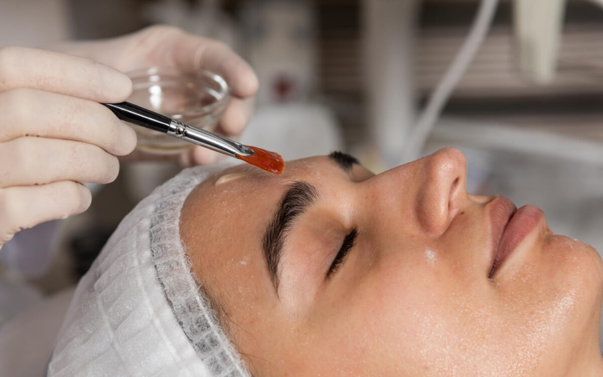Chemical Peels