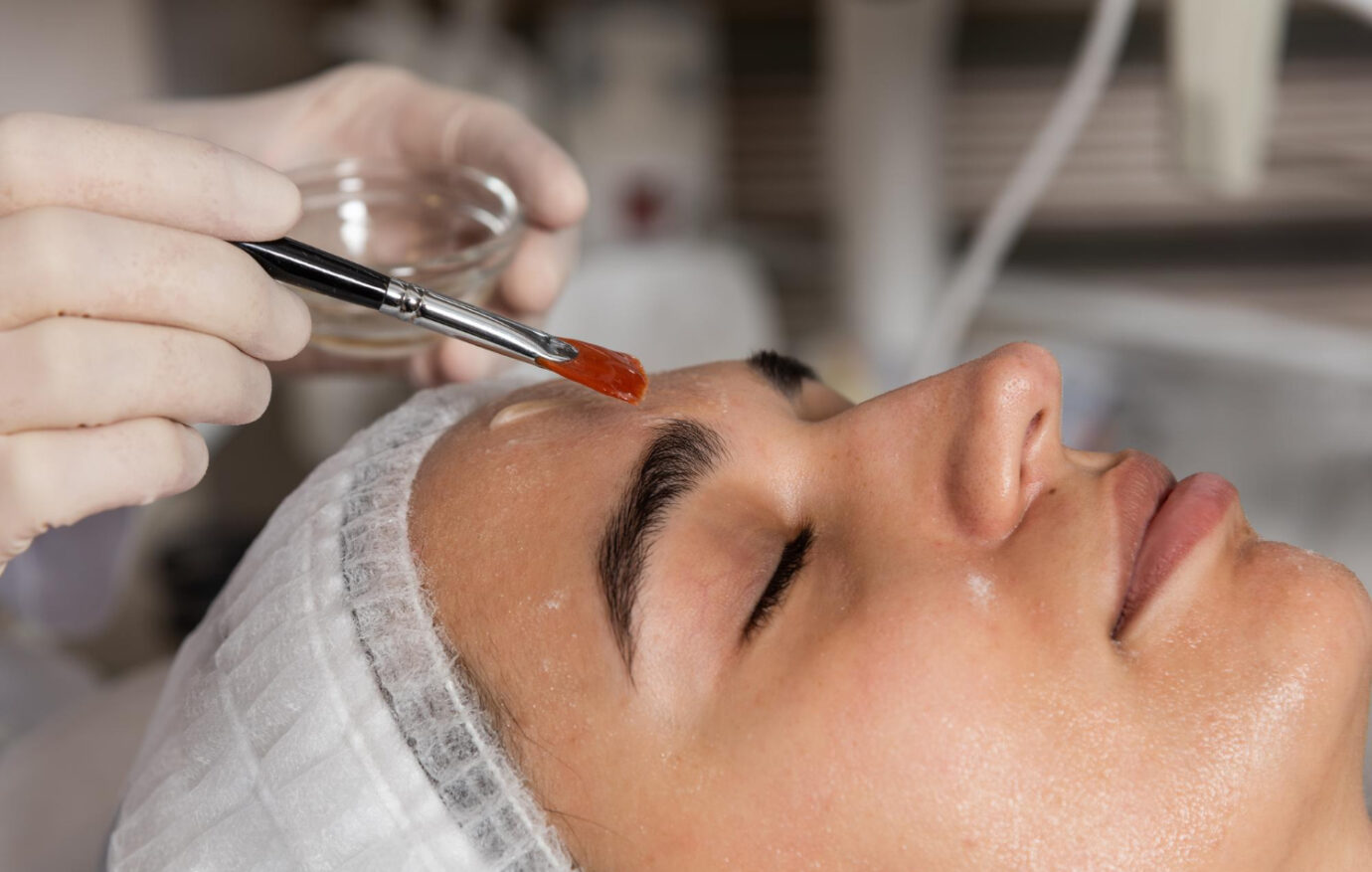 Chemical Peels